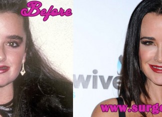 kyle richards plastic surgery