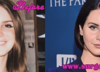 lana del rey plastic surgery