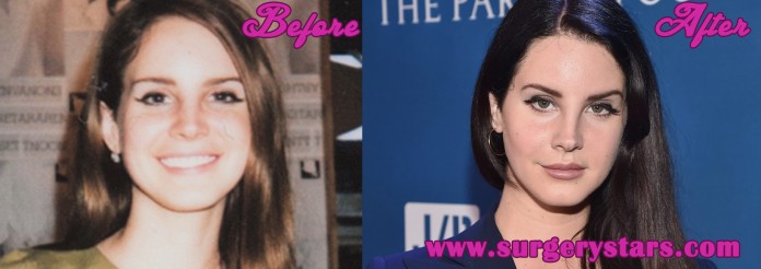 lana del rey plastic surgery