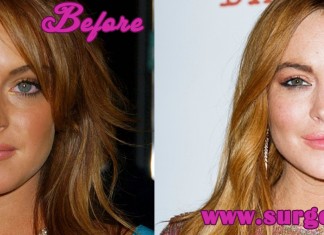 lindsay lohan plastic surgery