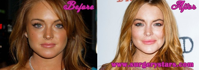 lindsay lohan plastic surgery