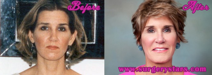 Mary Matalin Plastic Surgery