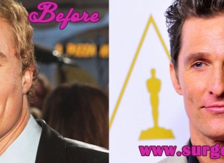Matthew McConaughey Plastic Surgery