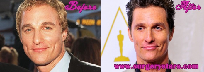 Matthew McConaughey Plastic Surgery