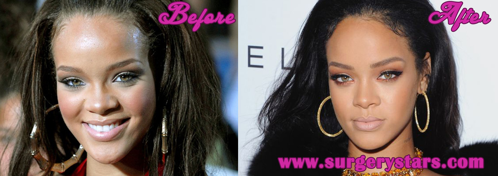 Rihanna Plastic Surgery Before After