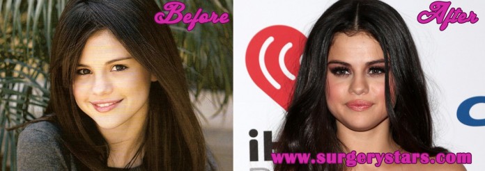 Selena Gomez Plastic Surgery