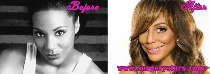 Tamar Braxton Plastic Surgery